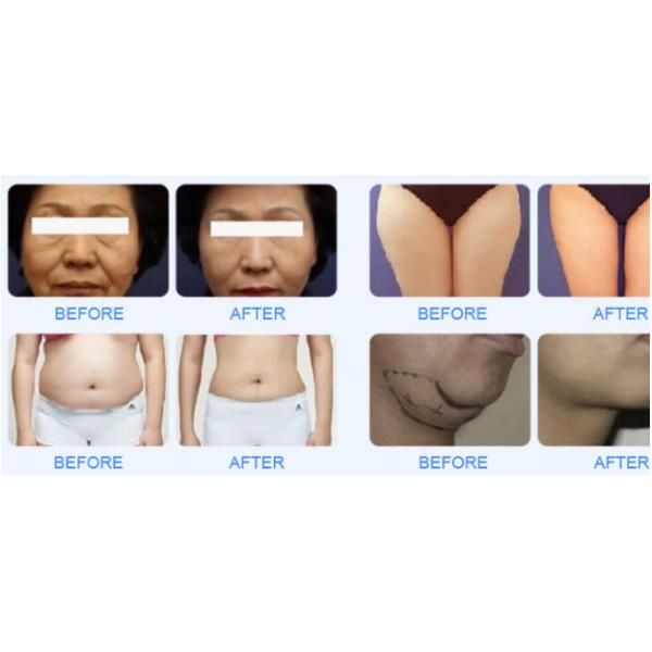 High Power Hifu Face Lifting Machine Effectively Solves Facial Sagging Problems