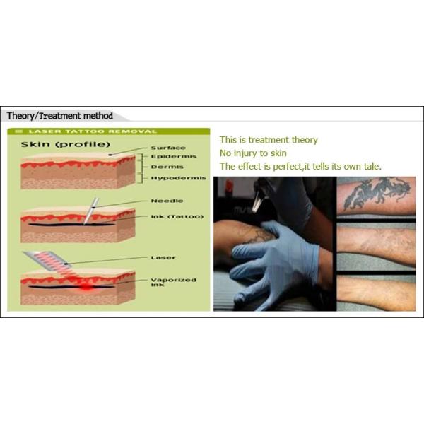 YAG IPL Laser Machine