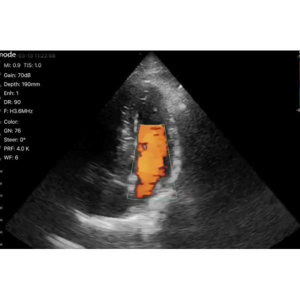 Wireless Phased Array Ultrasound Transducer Handheld Cardiac Echography Wireless Ultrasound Probe Price for Sale