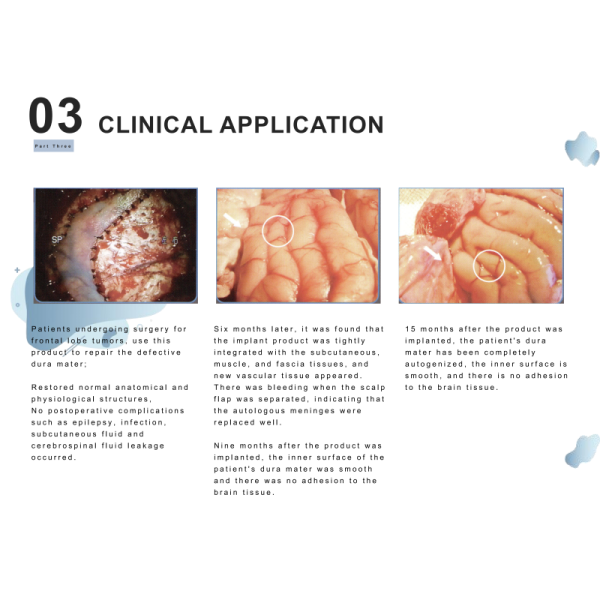 Biocompatible Porcine Pericardium Dura Patch Flexible Sutureable Dural Regeneration Matrix