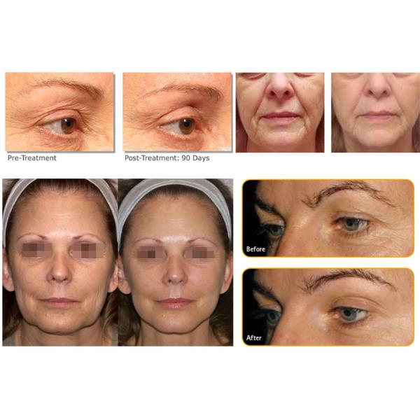 Best HIFU Face lifting Beauty Equipment