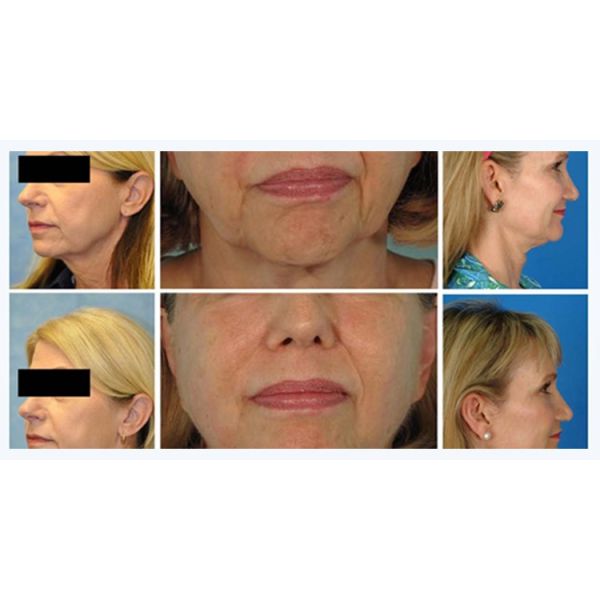 Face Lifting Wrinkle Removal HIFU Machine Belly Fat Reduce Multifunction Salon Machine