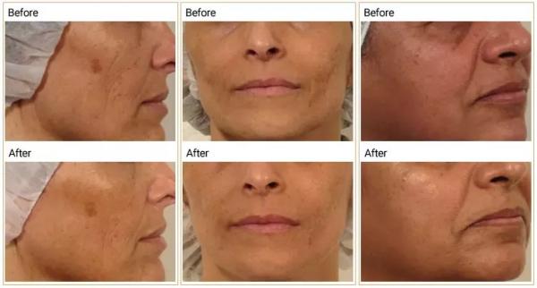 Lumenis Therapy Facial Salon Pollogen Machine / Device Pigment Removal