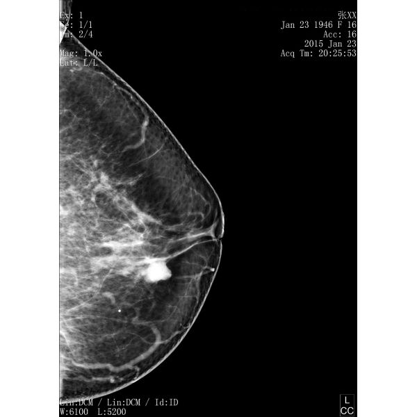 Full Digital Mammography System with Panel Detector for Sales
